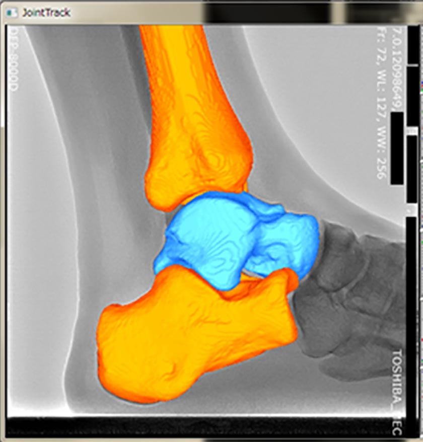 医用画像を用いた関節運動の解析の例